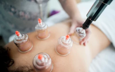 Dynamic cupping therapy session on a patient's back, showcasing glass cups applied for muscle recovery and performance enhancement.